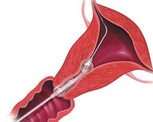 呼和浩特试管双胞胎(呼和浩特试管双胞胎事件)-供卵试管儿子