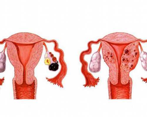 腺肌症会不会影响试管着床？腺肌症影响试管胚胎着床吗？,私人代生机构